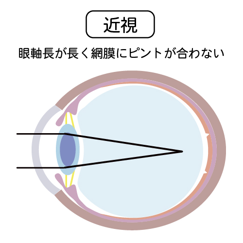 近視