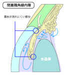緑内障なのに白内障手術って？狭隅角(閉塞隅角緑内障)を解説 | コラム – 経堂こうづき眼科
