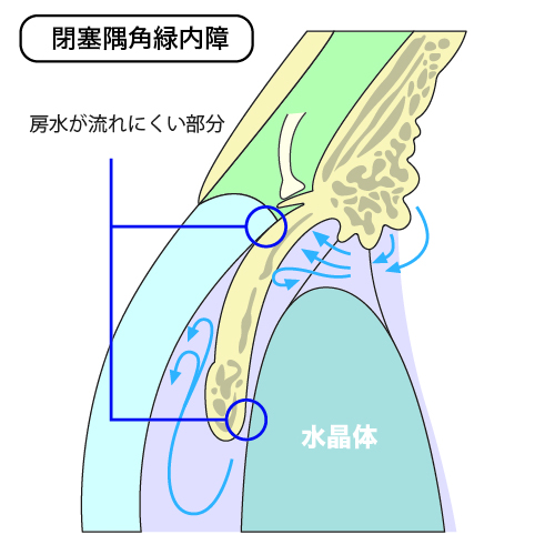 閉塞隅角緑内障