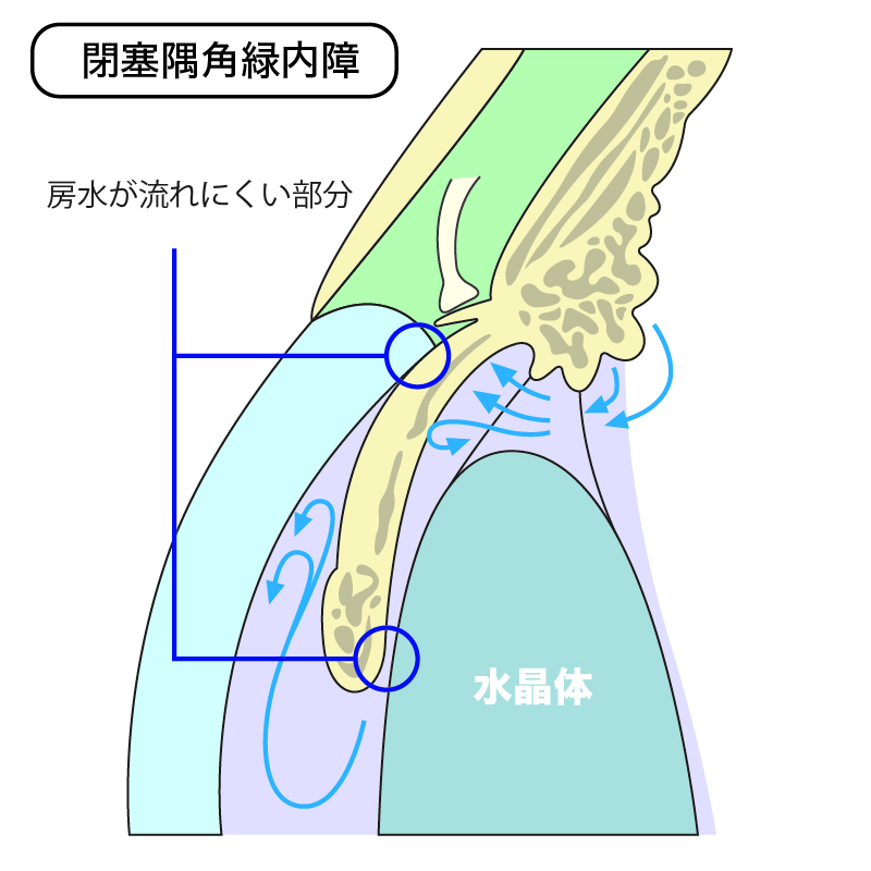 閉塞隅角緑内障