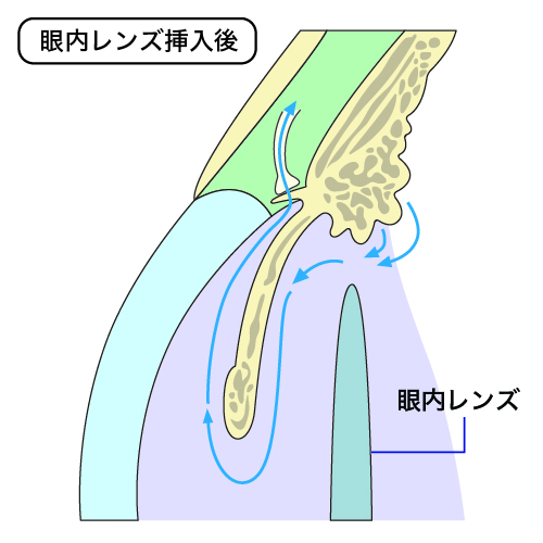 眼内レンズ挿入後