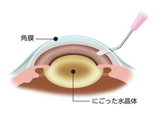 ①切開します