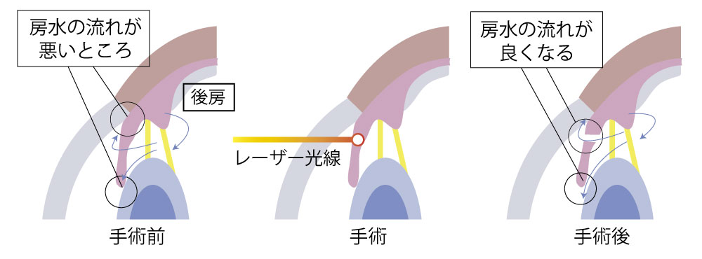 緑内障なのに白内障手術って？狭隅角(閉塞隅角緑内障)を解説