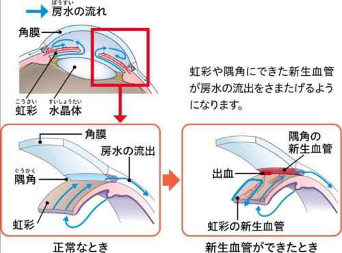 血管新生緑内障