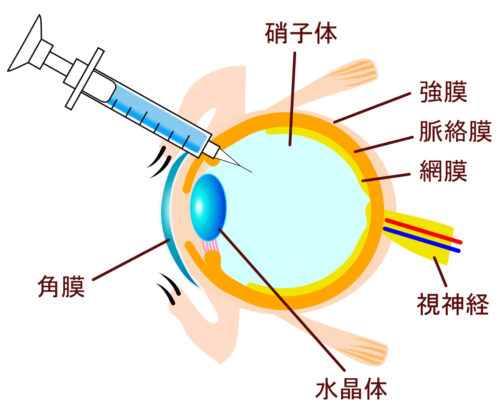 硝子体注射