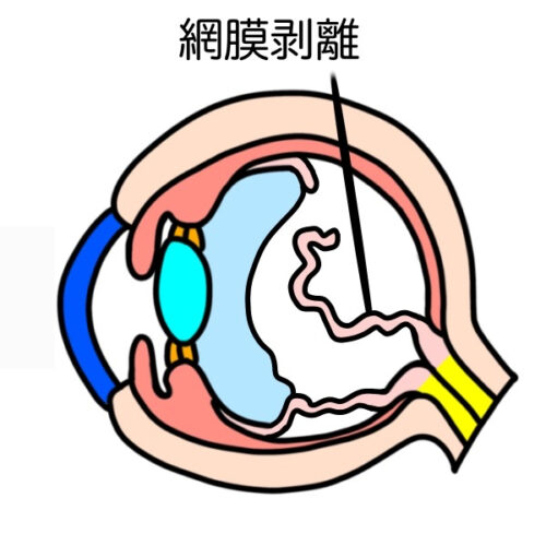 網膜剥離
