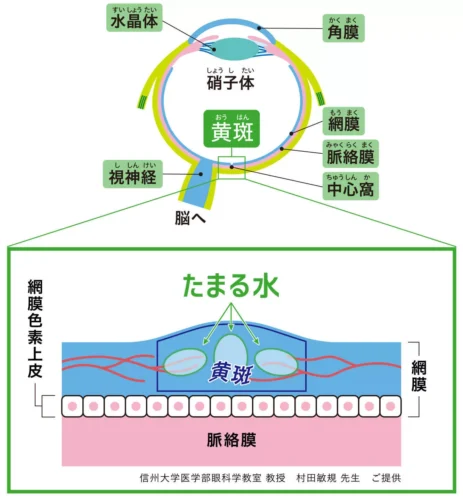 黄斑浮腫