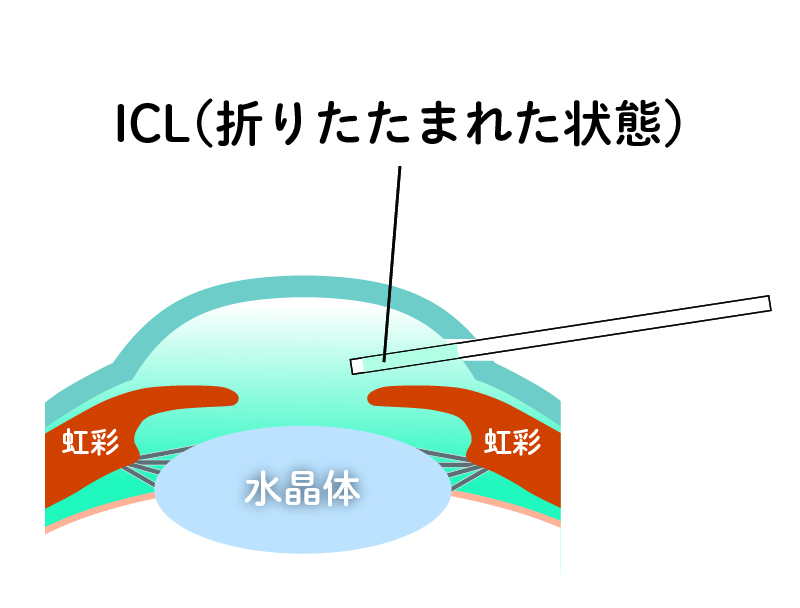 ICLはやめた方がいい?ICLのメリット・デメリットについて解説