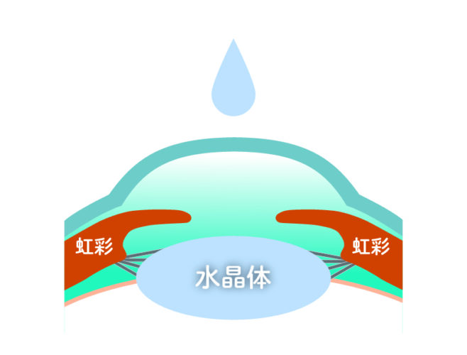 ICL挿入前