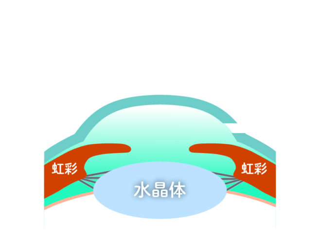 角膜切開