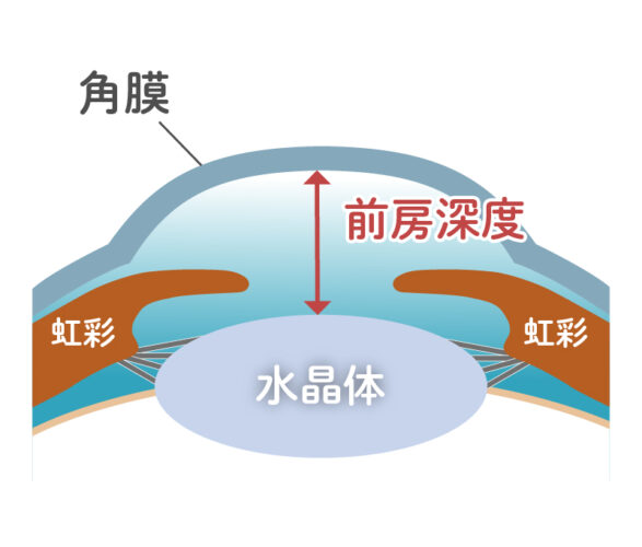 前房深度について