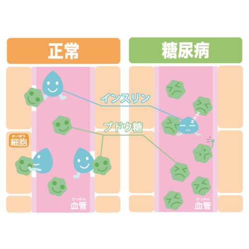 糖尿病の血管