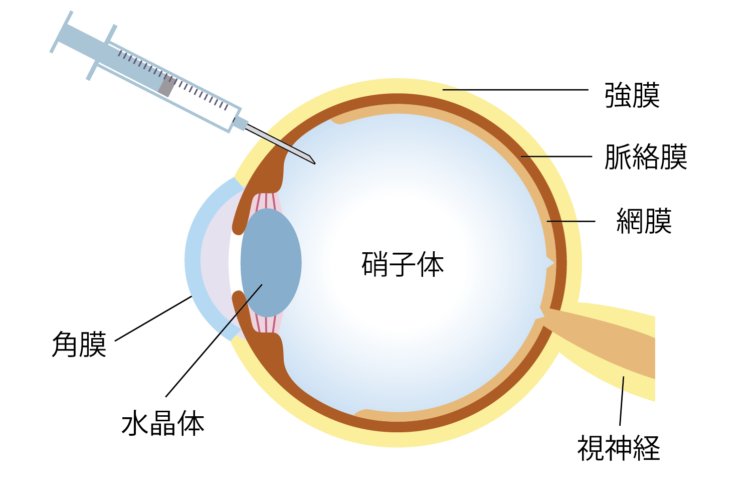 硝子体注射