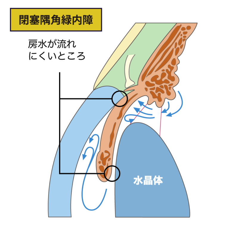 【LI(レーザー虹彩切開術)】狭隅角･閉塞隅角緑内障の治療法とは?急性緑内障発作による失明を防ぐ! | コラム – 経堂こうづき眼科
