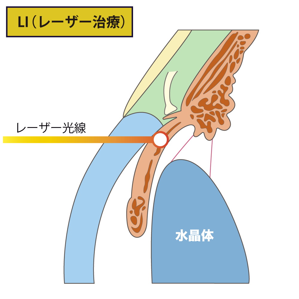 緑内障に対するレーザー治療法 – 緑内障 レーザー治療 術後 – HQUCJ