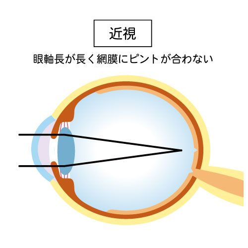 近視