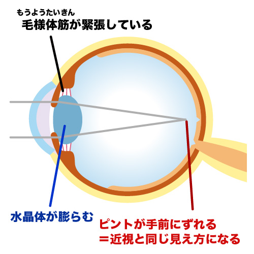 毛様体筋が緊張し、仮性近視になっている状態