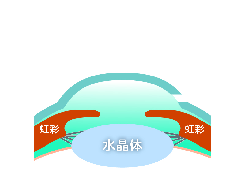 角膜切開