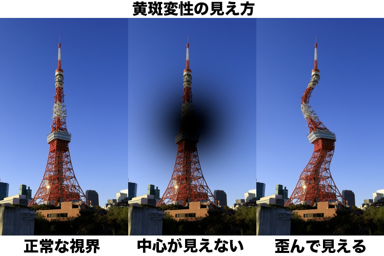 黄斑変性の見え方