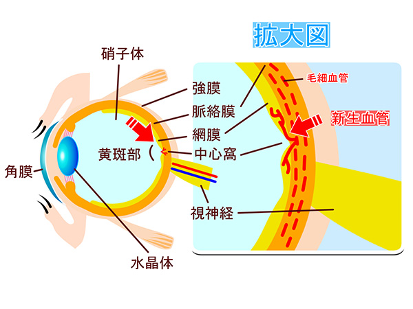 新生血管発生