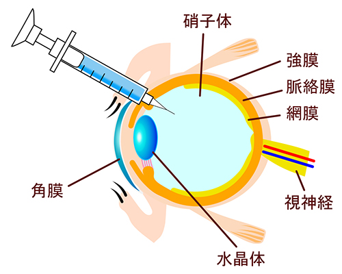 硝子体注射とは