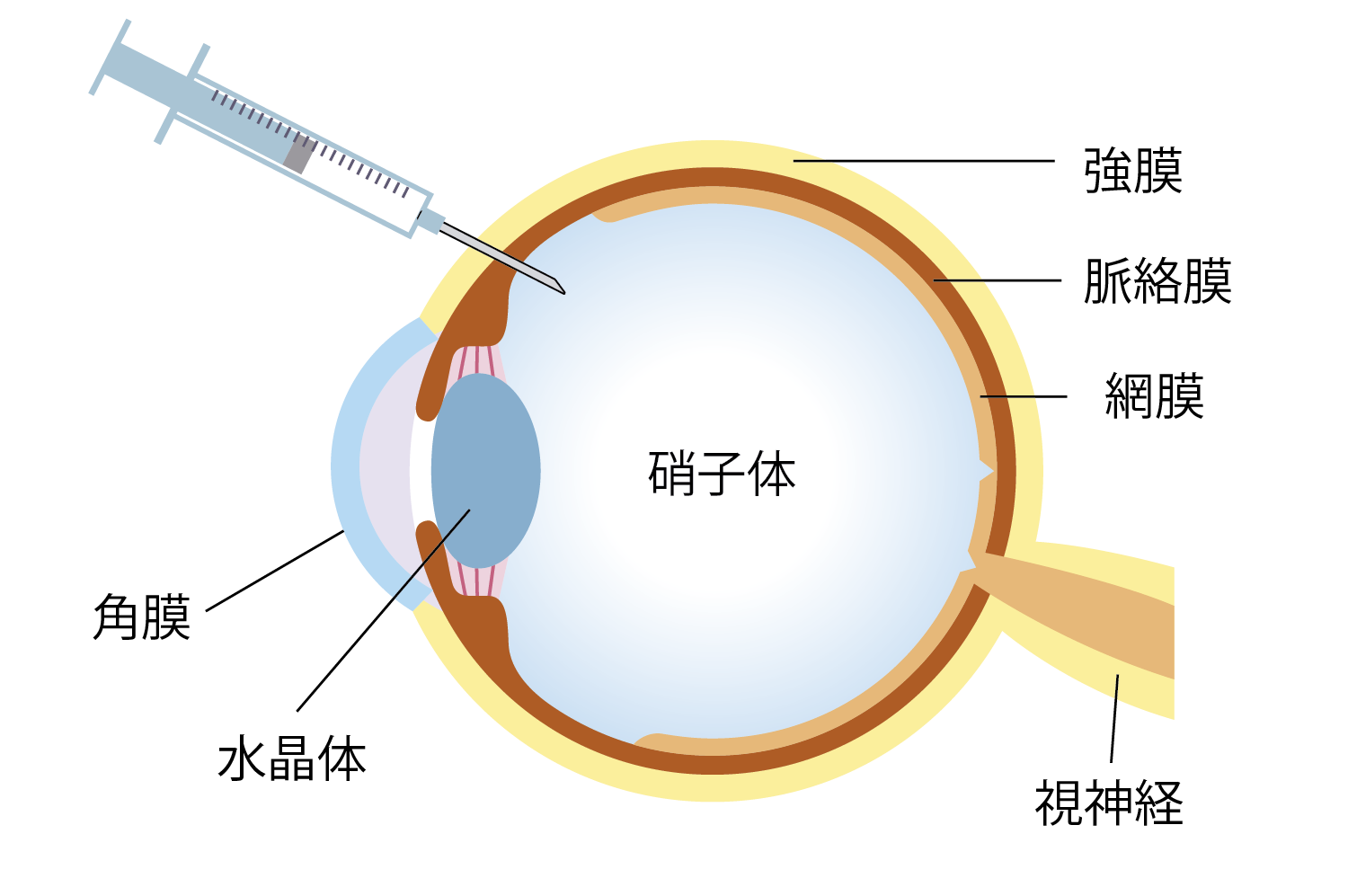 硝子体注射とは