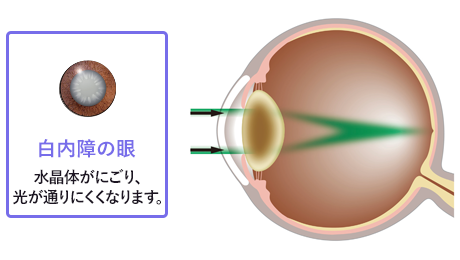 白内障の眼