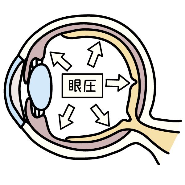 緑内障