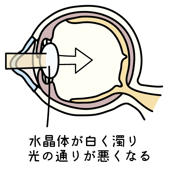 白内障