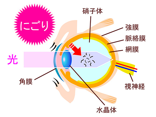 病気に伴う飛蚊症