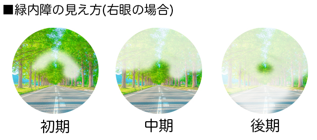緑内障の視界