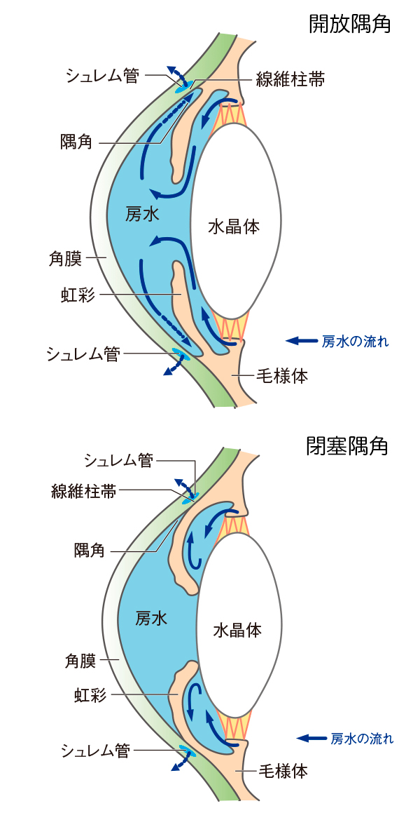 開放隅角と閉塞隅角