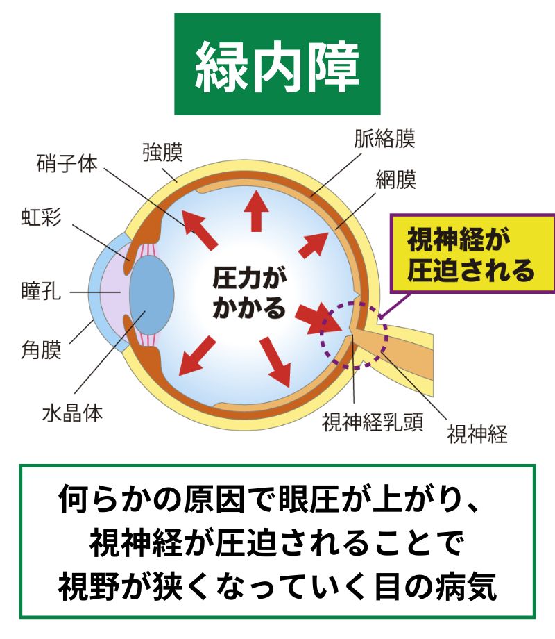 緑内障
