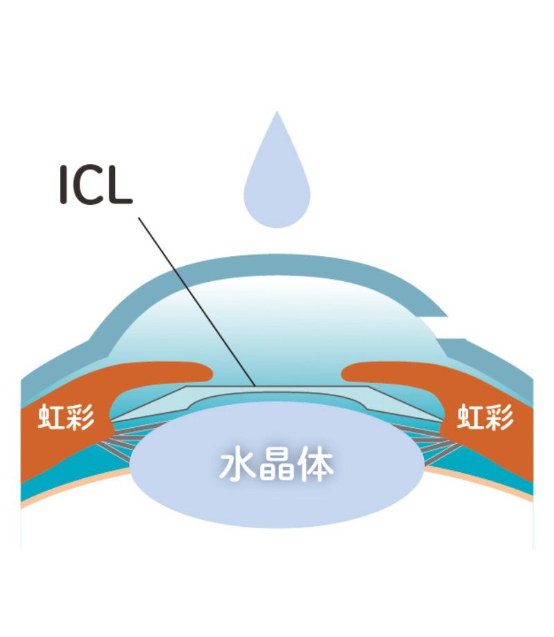 ICL