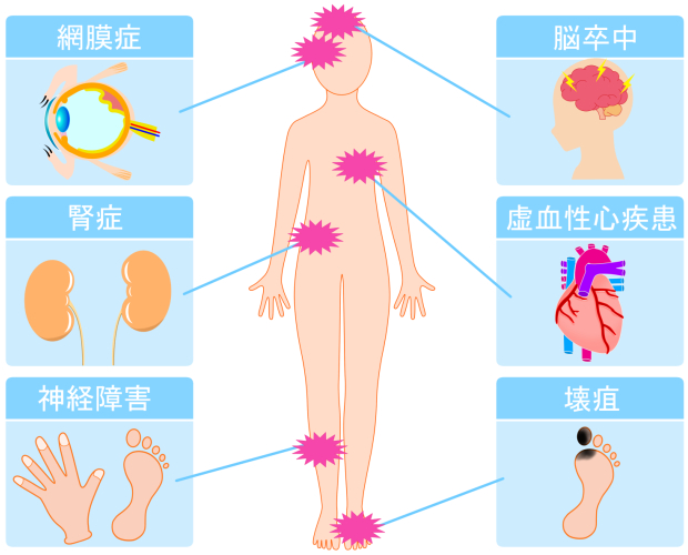 糖尿病の合併症