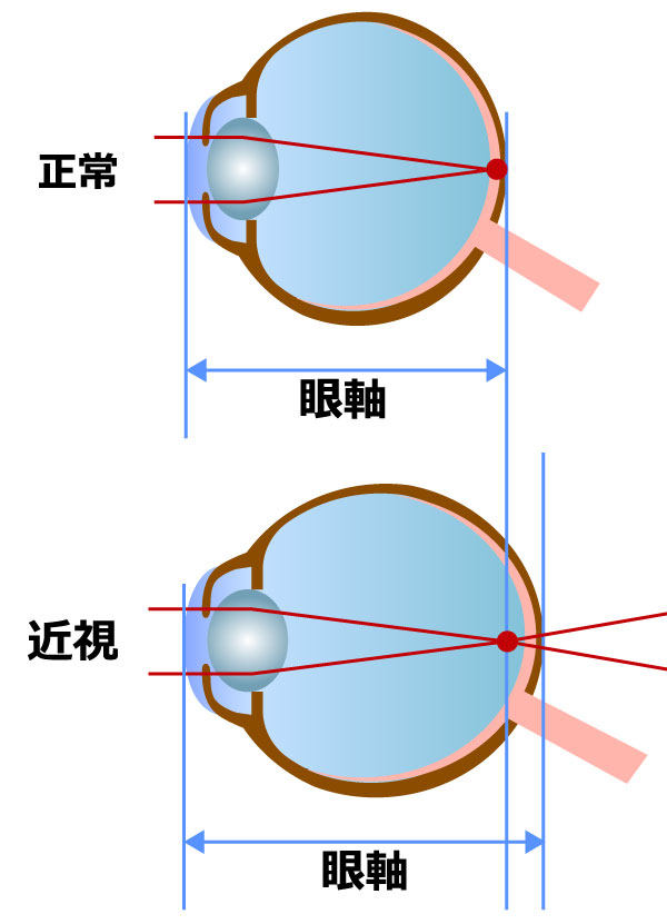 近視性脈絡膜新生血管
