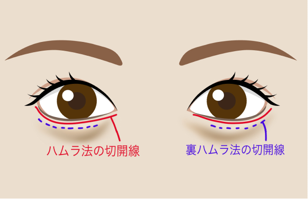裏ハムラ法