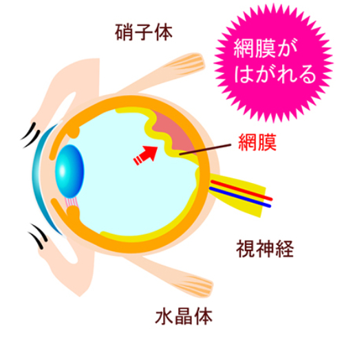 レーザー治療