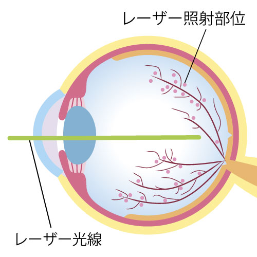 レーザー治療