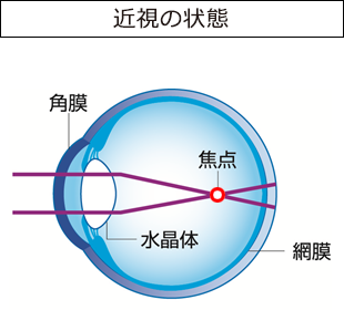 オルソケラトロジーによる近視矯正の仕組み1