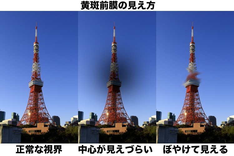 黄斑全幕の見え方
