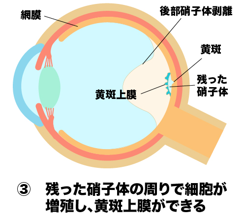 残った硝子体の周囲で細胞が増殖