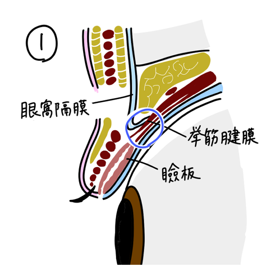 挙筋腱膜前転術１