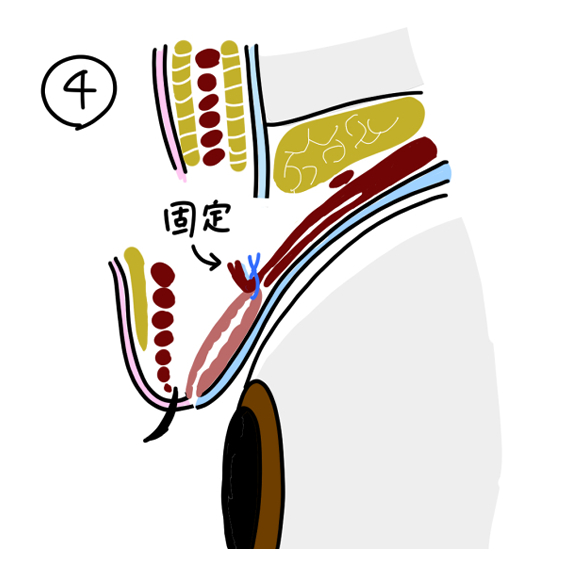 挙筋腱膜前転術１