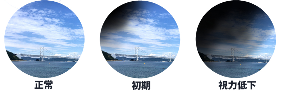 視野欠損