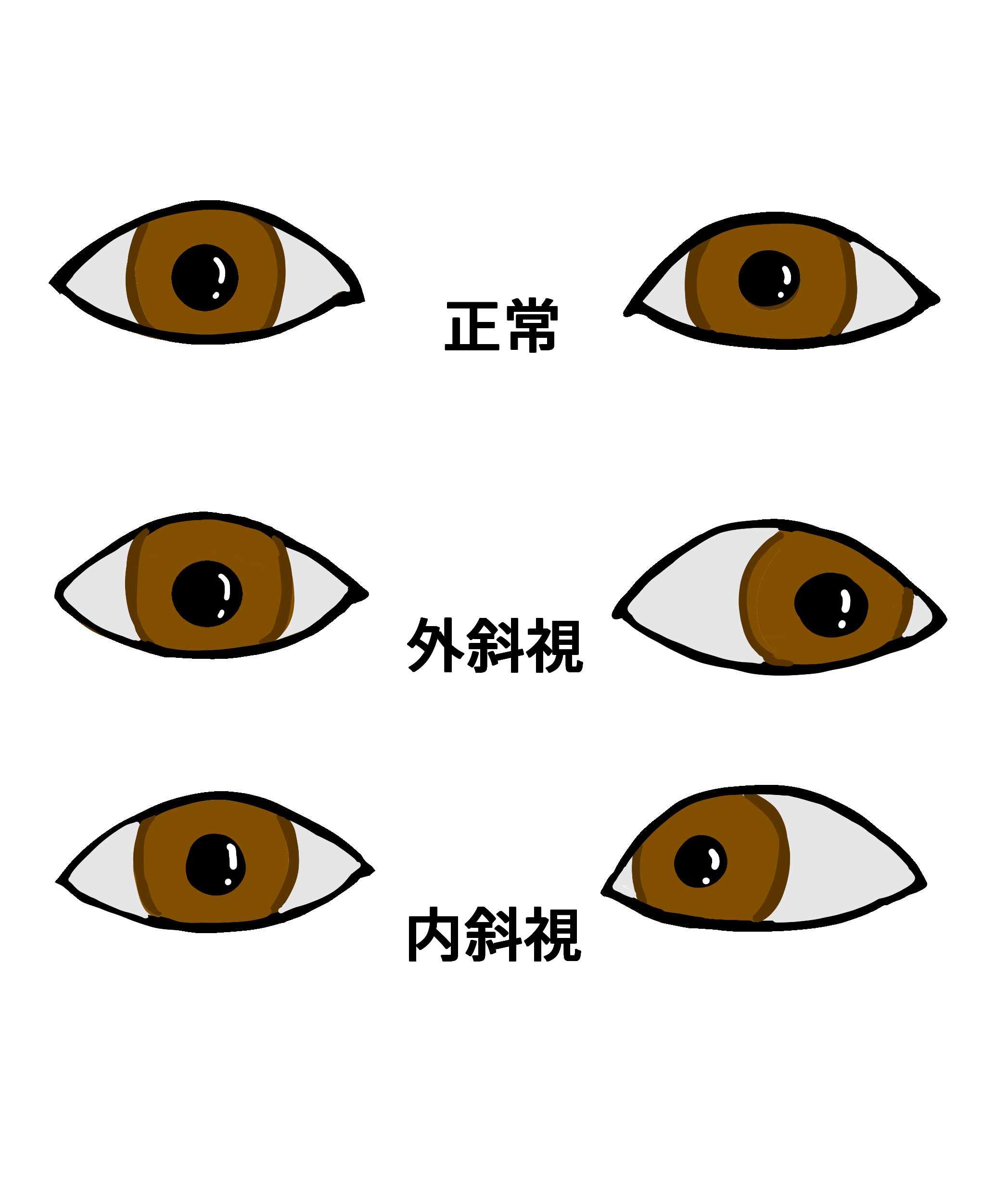 斜視